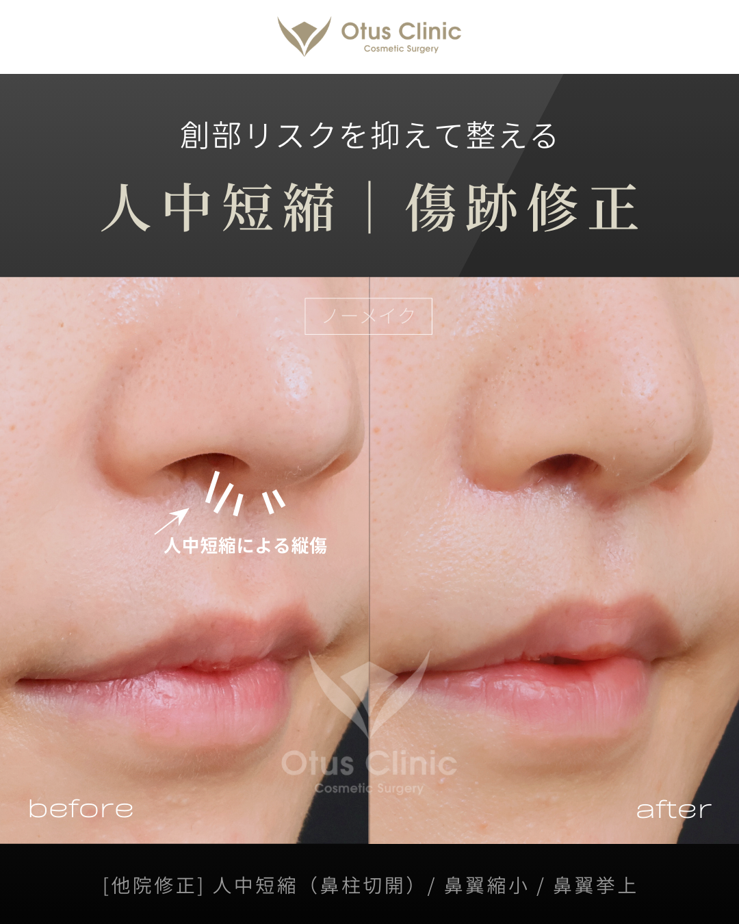 【他院修正】鼻柱切開人中短縮・鼻翼縮小・鼻翼挙上