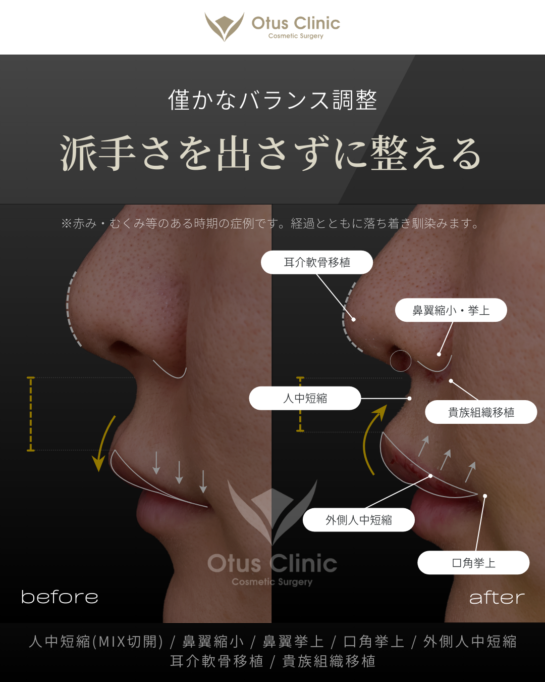 人中短縮(鼻柱切開×鼻孔内切開)・鼻翼縮小・鼻翼挙上・口角挙上・外側人中短縮・貴族組織移植・耳介軟骨移植