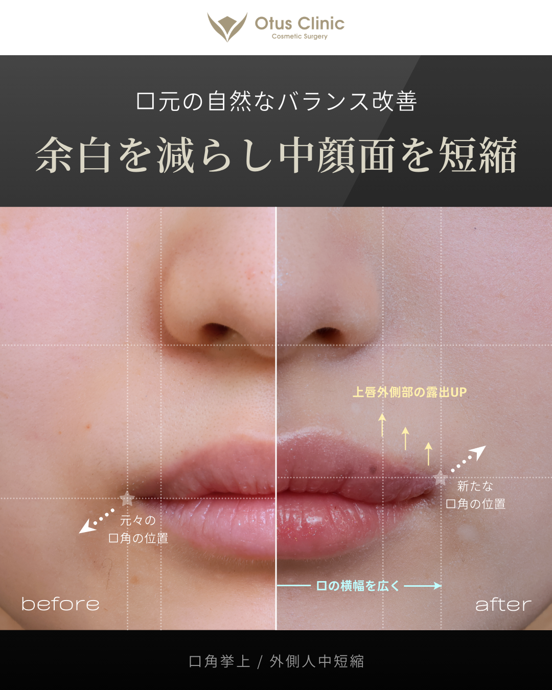 口角挙上・外側人中短縮