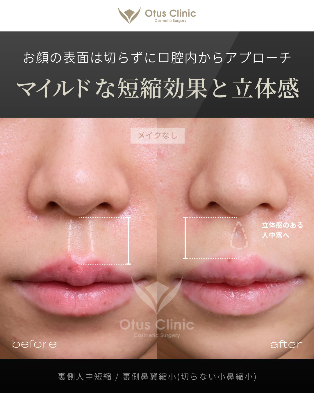 裏側人中短縮（切らない人中短縮）・裏側鼻翼縮小（切らない小鼻縮小）