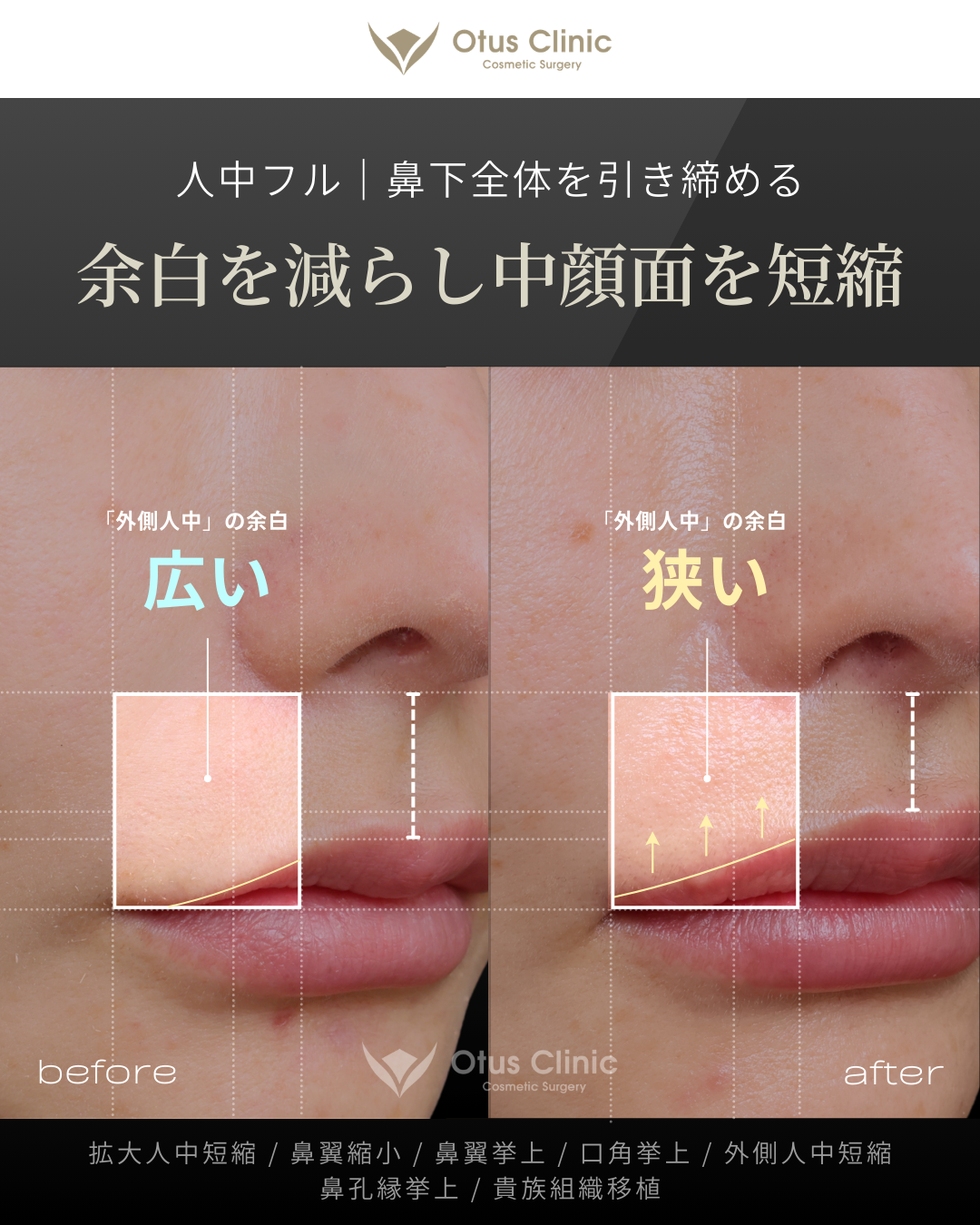 人中フル（人中短縮＋鼻翼縮小＋鼻翼挙上＋口角挙上＋外側人中短縮）・拡大人中短縮・貴族組織移植・鼻孔縁挙上