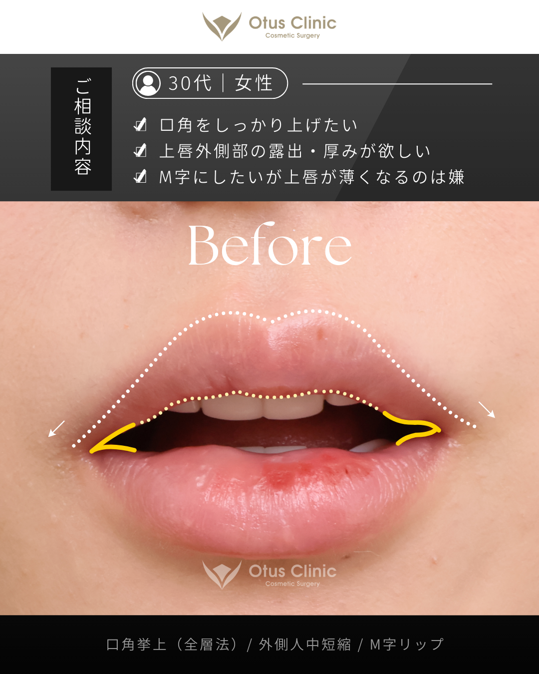 口角挙上（全層法）・外側人中短縮・M字リップ