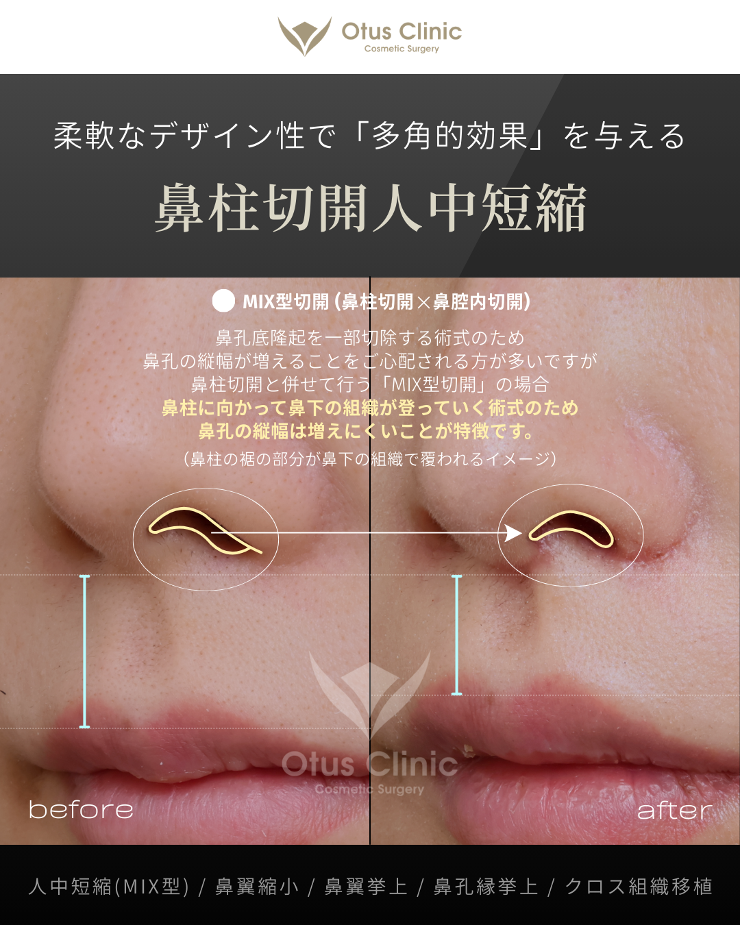 人中短縮(鼻柱切開×鼻腔内切開)・鼻翼縮小・鼻翼挙上・鼻孔縁挙上・クロス組織移植