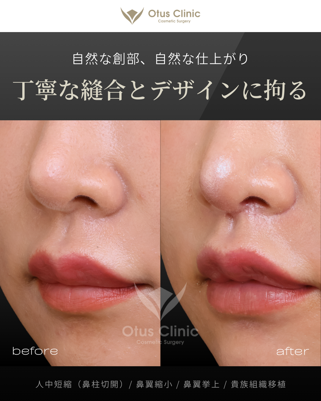 鼻柱切開人中短縮・貴族組織移植・鼻翼縮小・鼻翼挙上