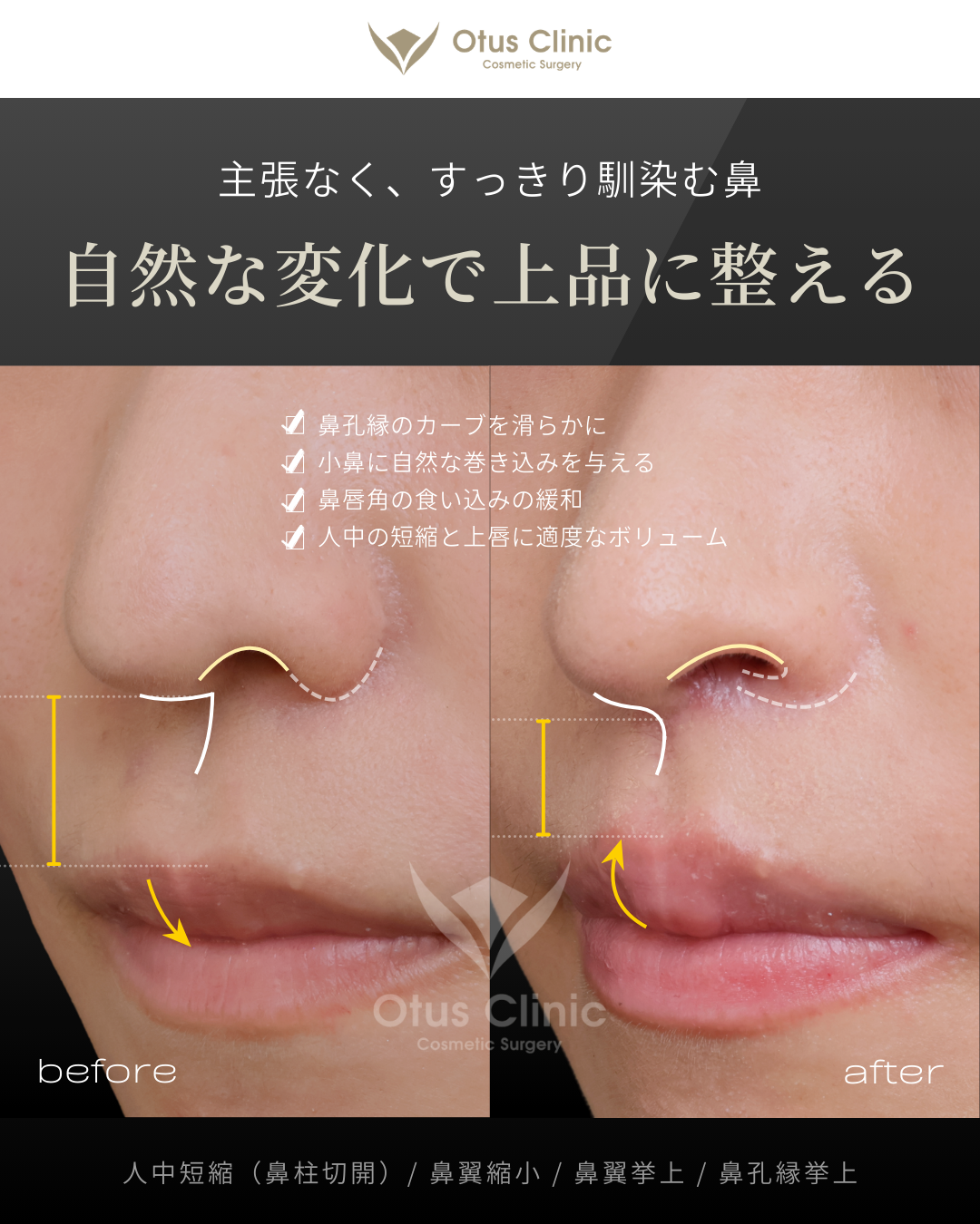 鼻柱切開人中短縮・鼻翼縮小・鼻翼挙上・鼻孔縁挙上