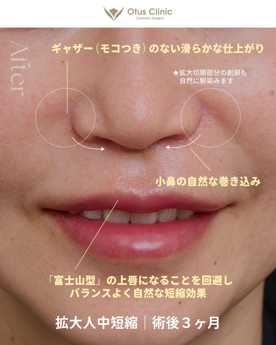 拡大人中短縮（MIX切開）/ 鼻翼縮小 / 鼻翼挙上 / 鼻孔縁挙上