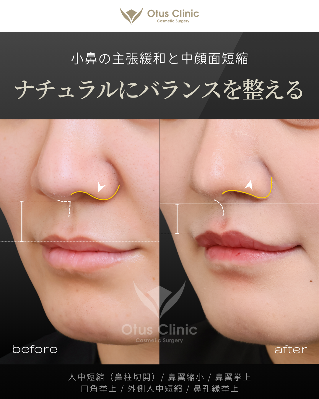 鼻柱切開人中短縮・鼻翼縮小・鼻翼挙上・口角挙上・外側人中短縮 ・鼻孔縁挙上