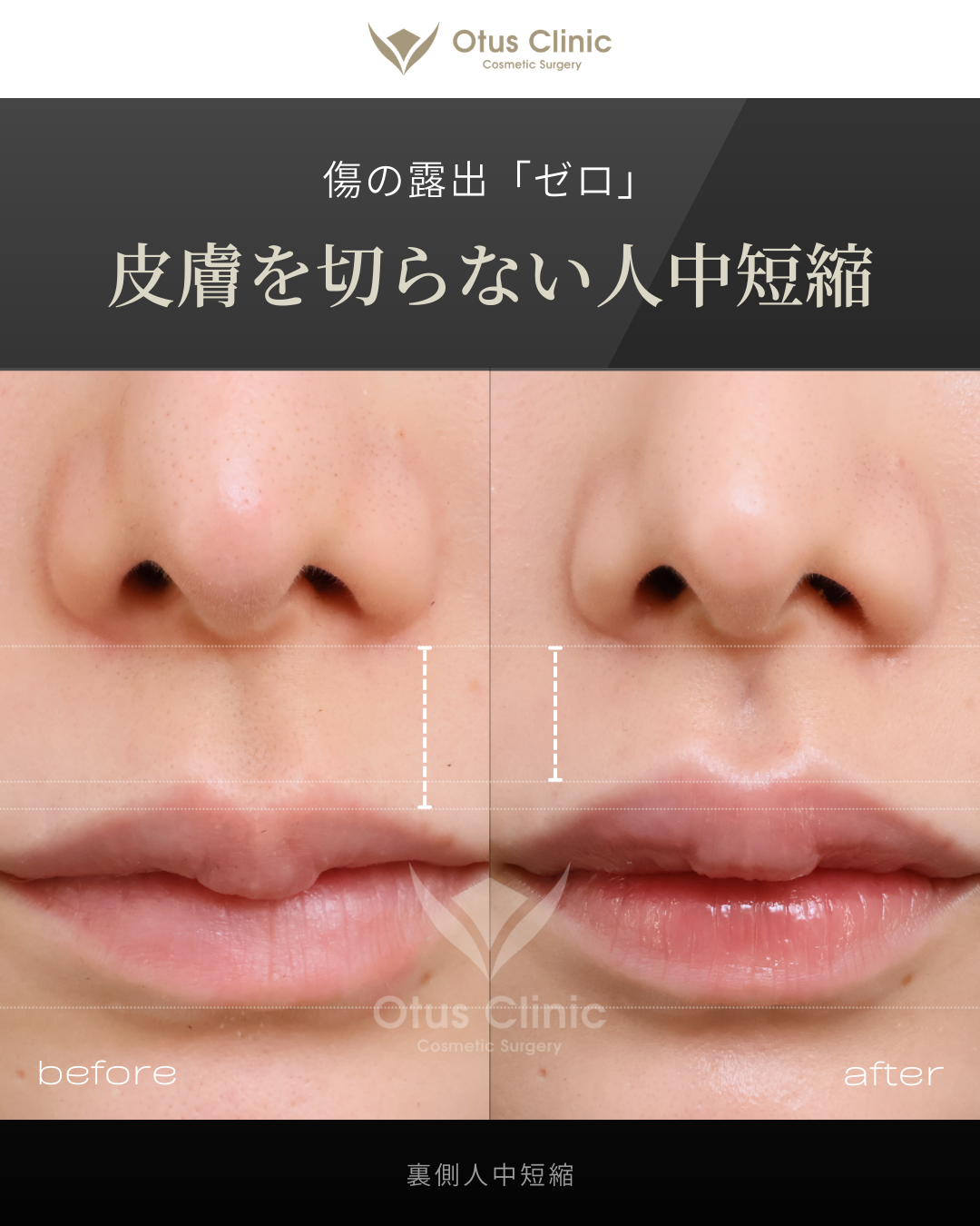 裏側人中短縮（切らない人中短縮）