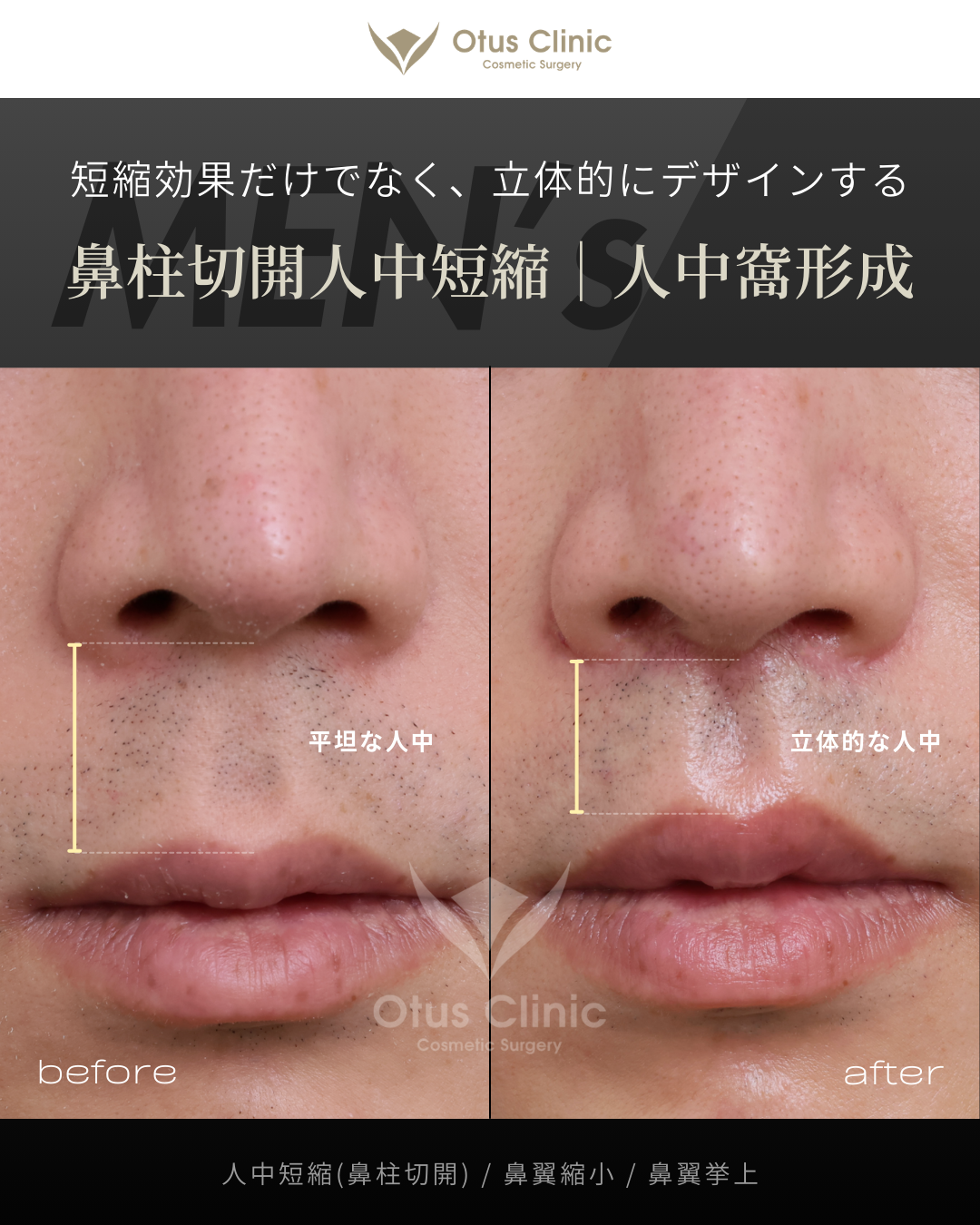 鼻柱切開人中短縮・鼻翼縮小・鼻翼挙上