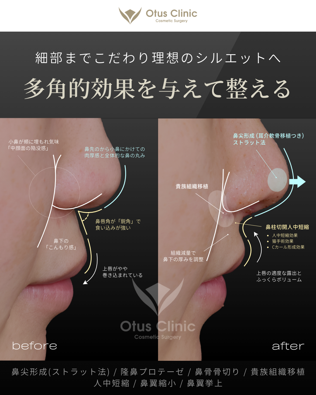 鼻尖形成(耳介軟骨移植つき)・ストラット法・隆鼻プロテーゼ・鼻骨骨切り・貴族組織移植・鼻柱切開人中短縮・鼻翼縮小・鼻翼挙上