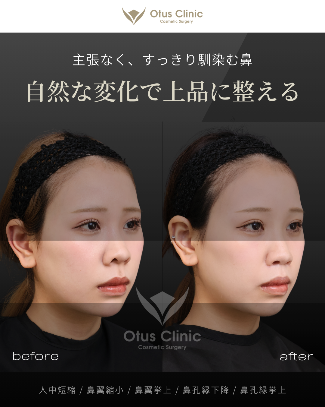 人中短縮・鼻翼縮小・鼻翼挙上・鼻孔縁下降・鼻孔縁挙上