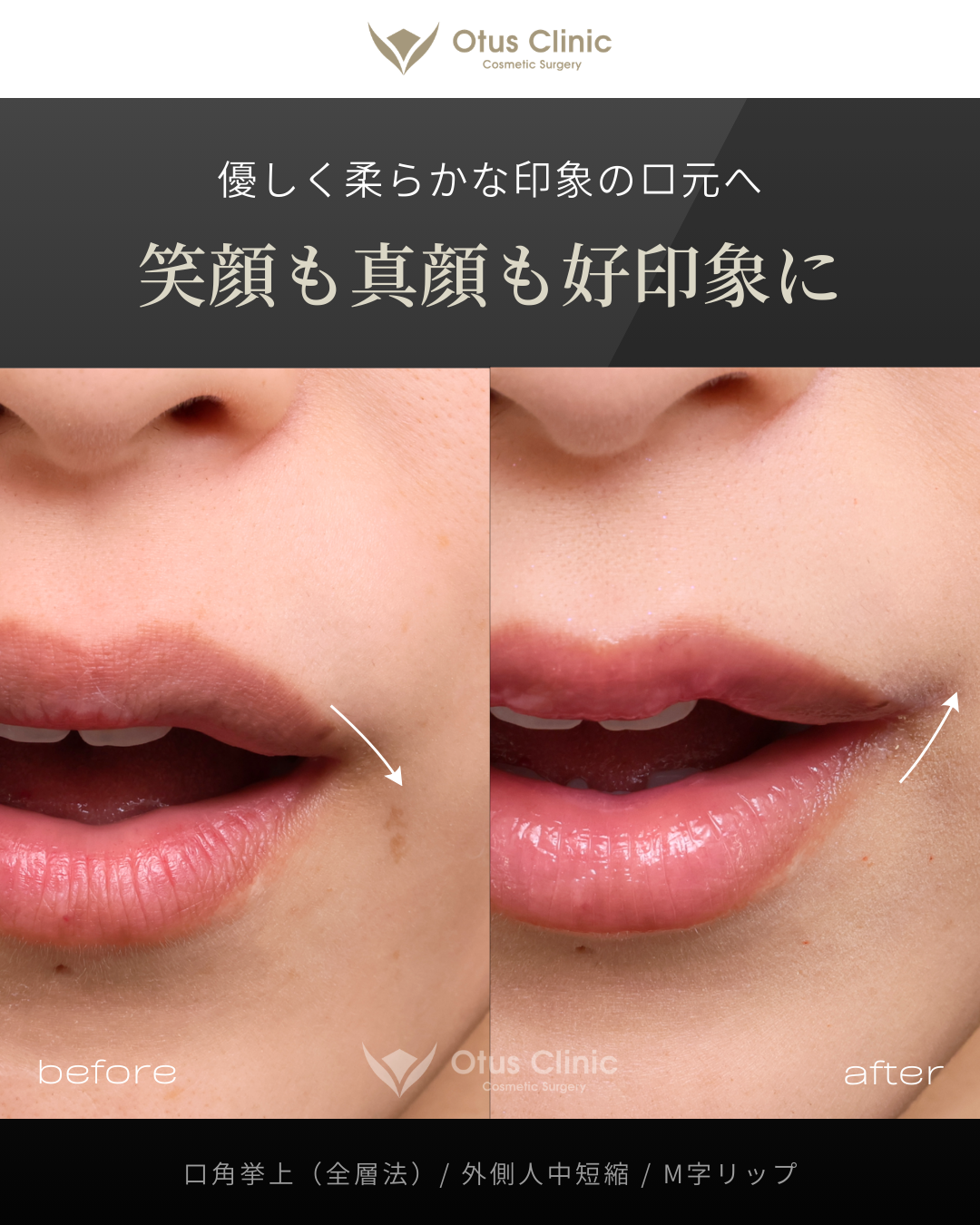 口角挙上（全層法）・外側人中短縮・M字リップ