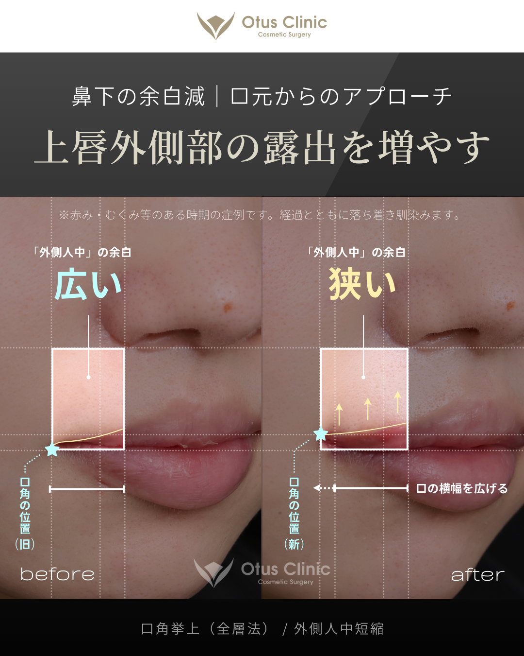 口角挙上（全層法）・外側人中短縮