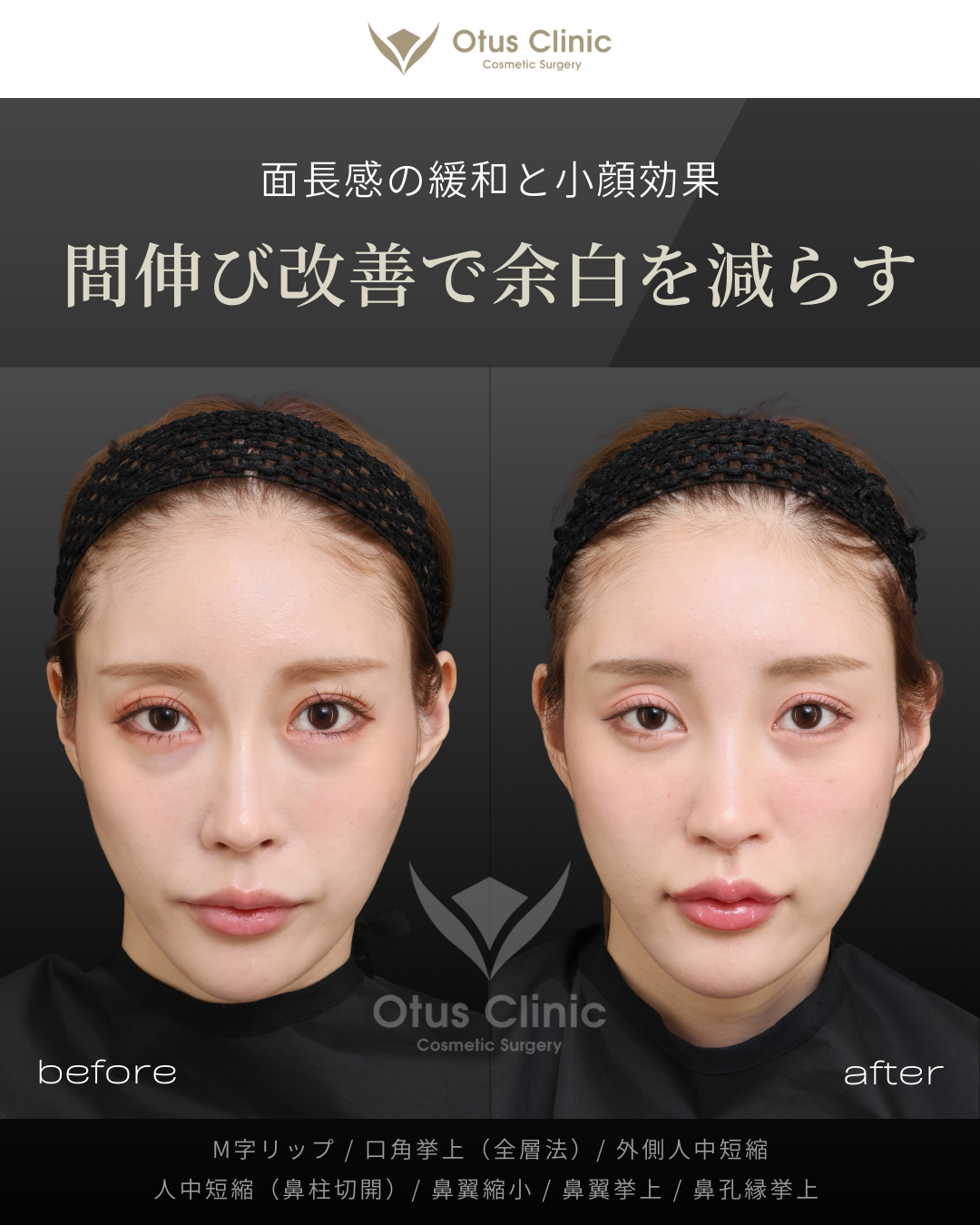 M字リップ ・鼻孔縁挙上 ・人中フル（人中短縮 / 鼻翼縮小 / 鼻翼挙上 / 外側人中短縮 / 口角挙上）