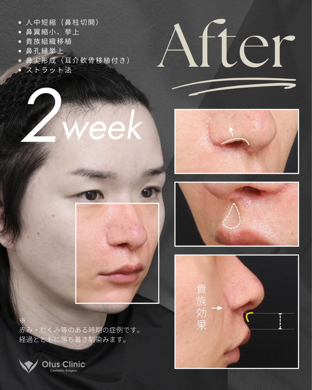 鼻柱切開人中短縮・鼻翼縮小・鼻翼挙上・貴族組織移植・鼻孔縁挙上 ・鼻尖形成（耳介軟骨移植付き）・ストラット法