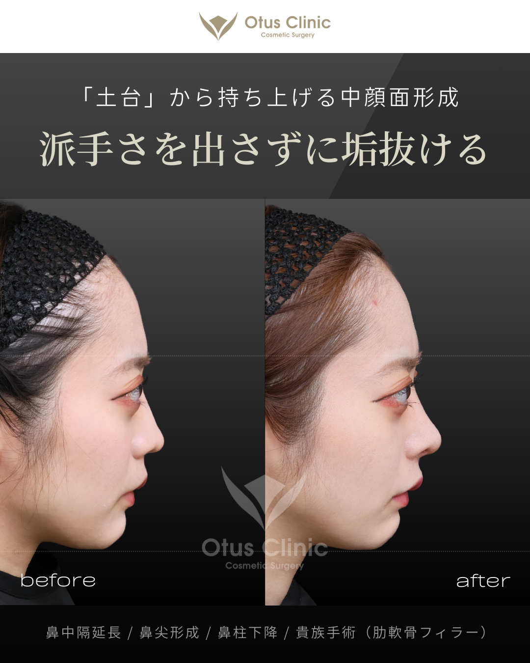 鼻中隔延長（肋軟骨）・鼻尖形成・鼻柱下降・貴族手術（肋軟骨フィラー）