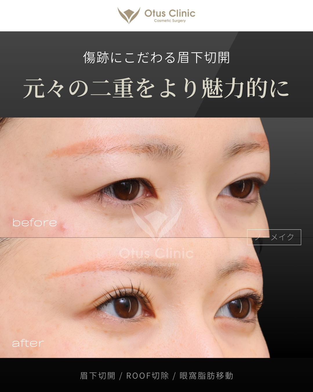 眉下切開・ROOF切除・眼窩脂肪移動