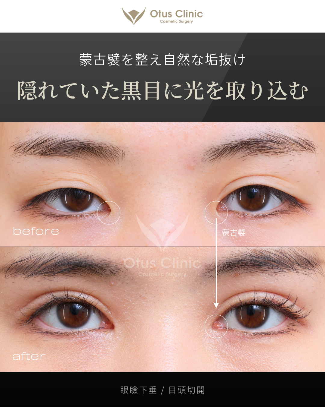 眼瞼下垂・目頭切開