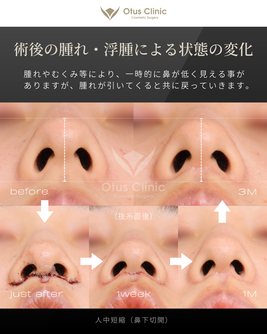 人中短縮(鼻下切開)