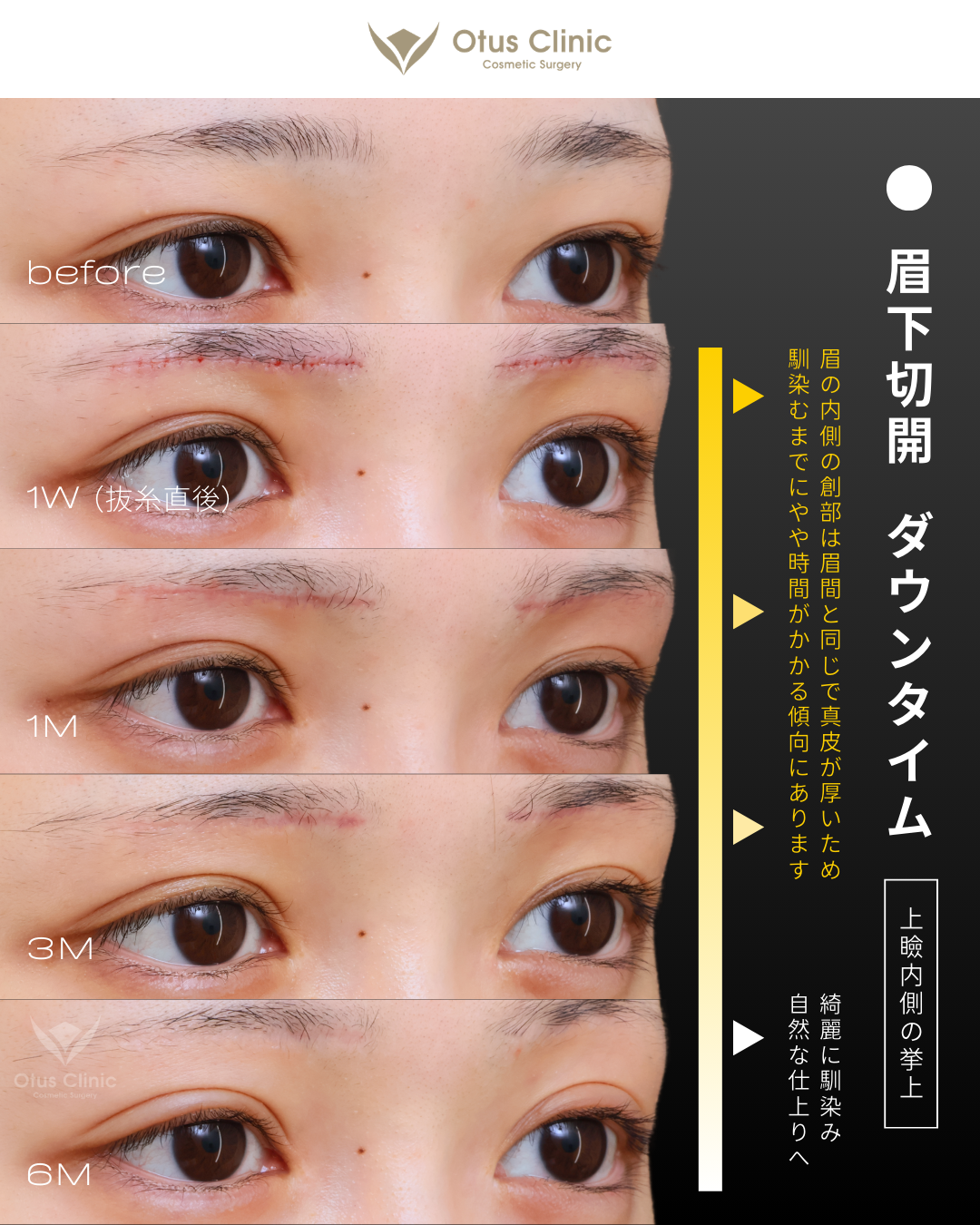 眉下切開・ROOF切除・眼窩脂肪移動