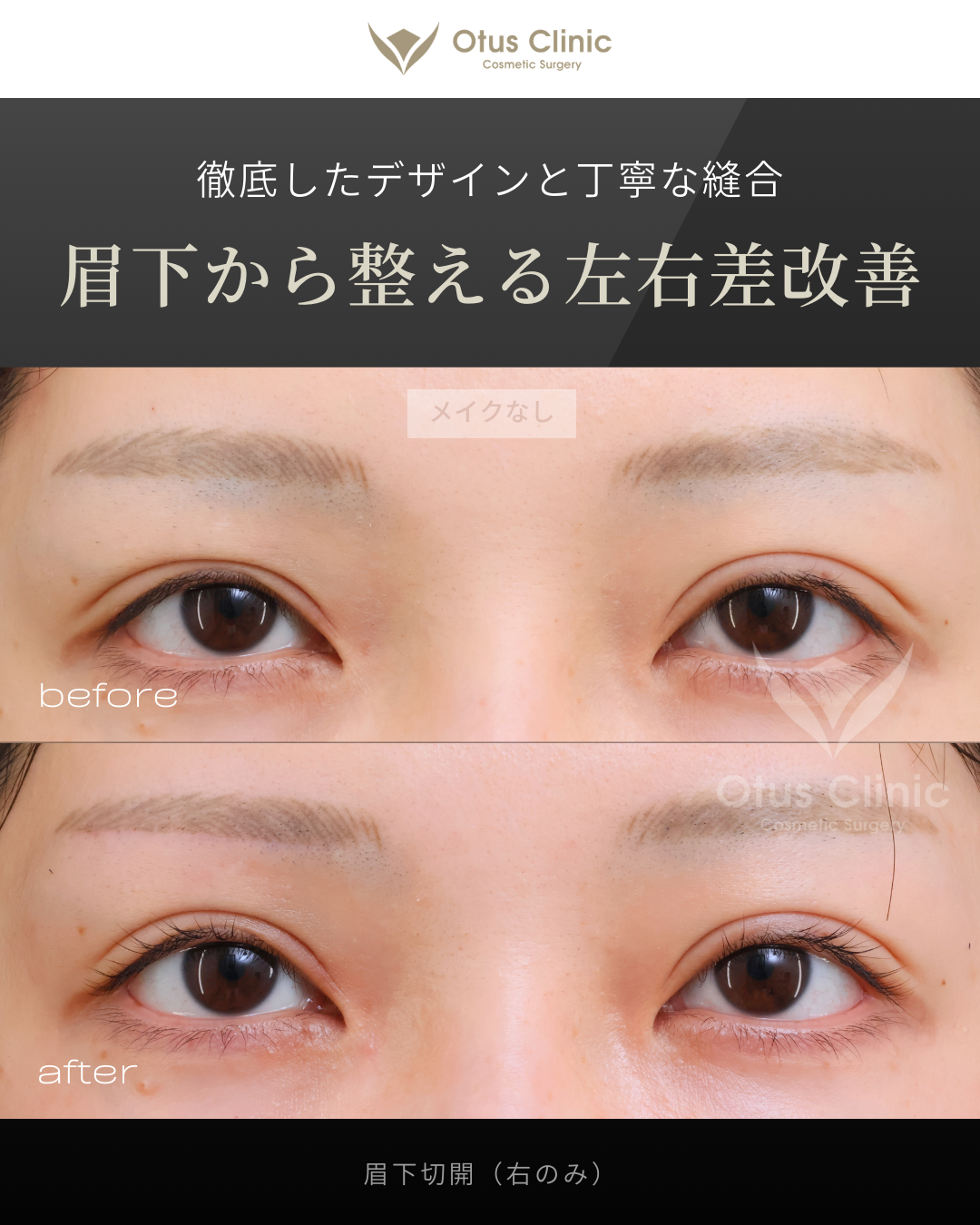 眉下切開（右のみ）