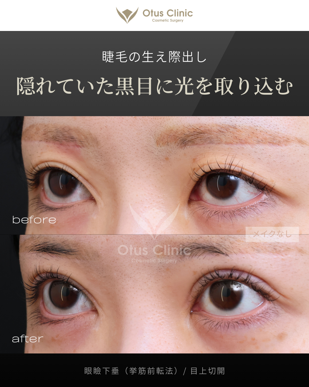 眼瞼下垂（挙筋前転法）・目上切開