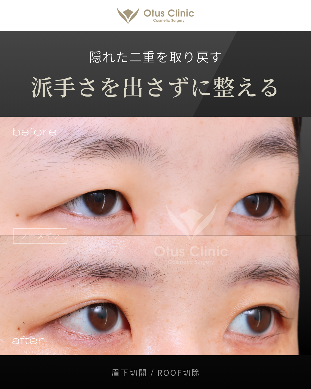 眉下切開・ROOF切除