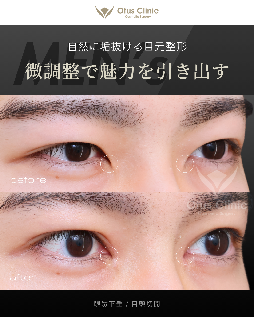 眼瞼下垂・目頭切開