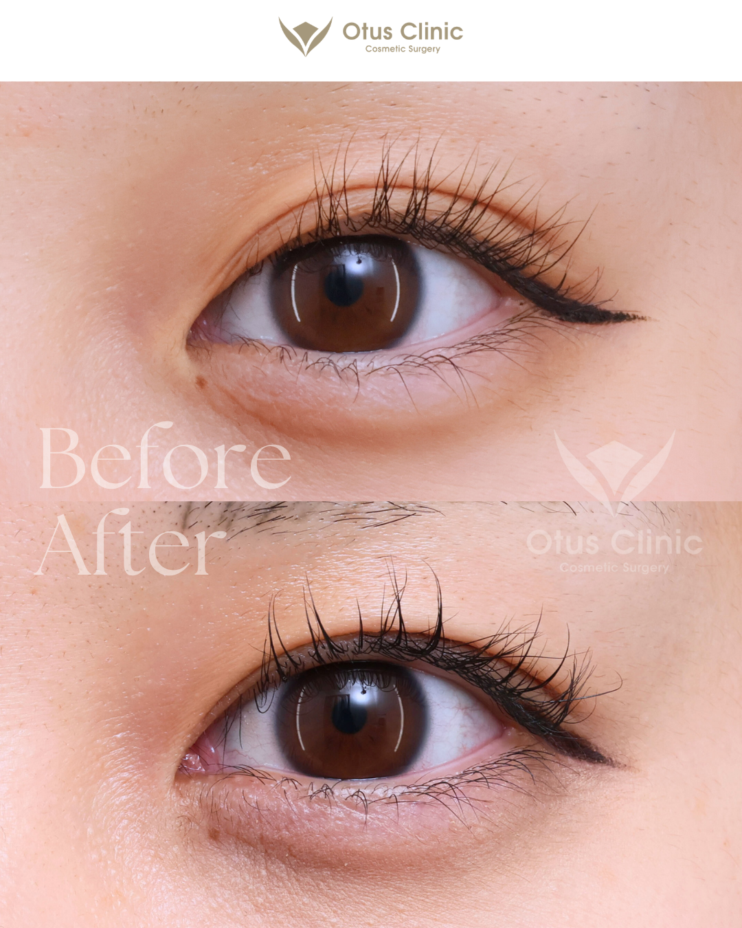 目上切開・目頭切開