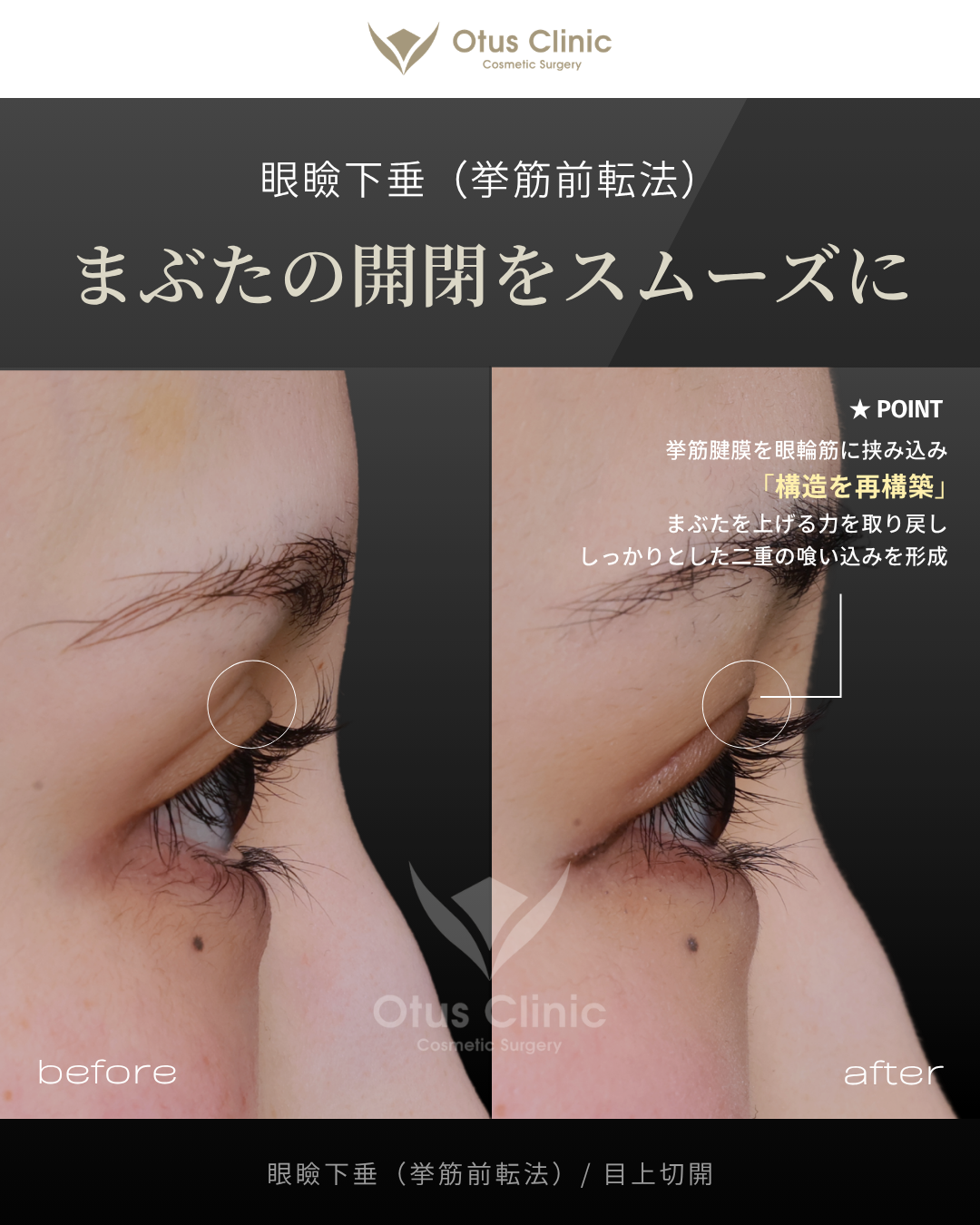 眼瞼下垂（挙筋前転法）・目上切開