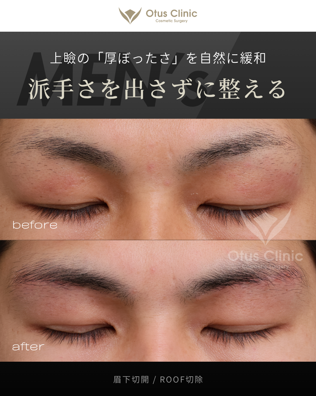 眉下切開・ROOF切除