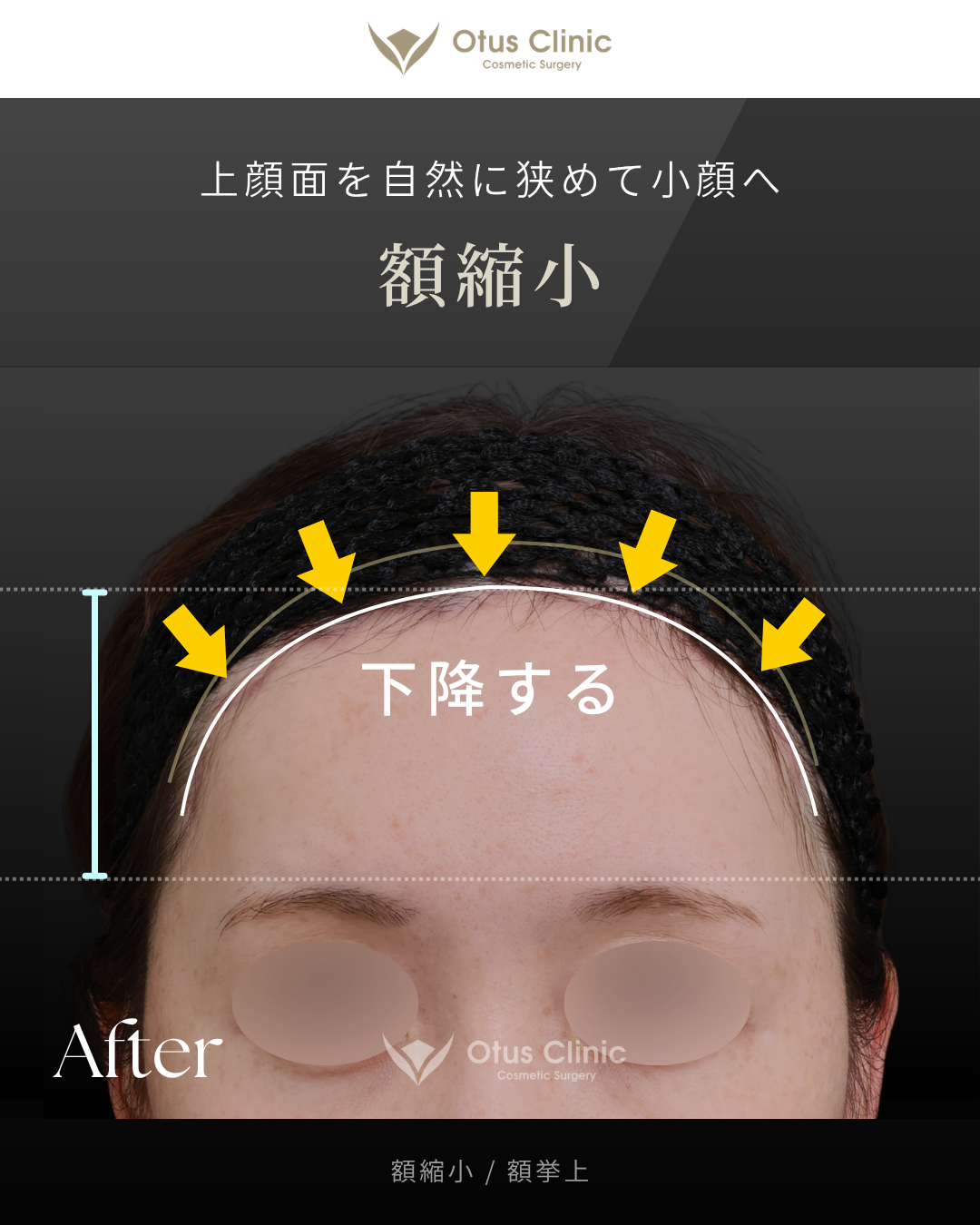 額縮小・額挙上（前額リフト）
