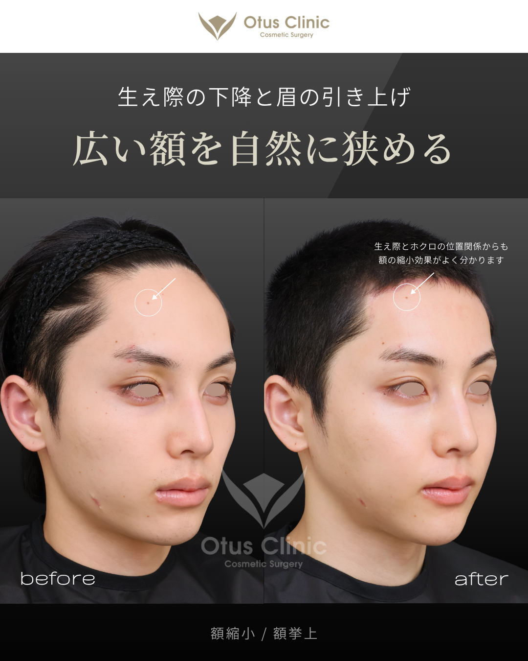 額縮小・額挙上