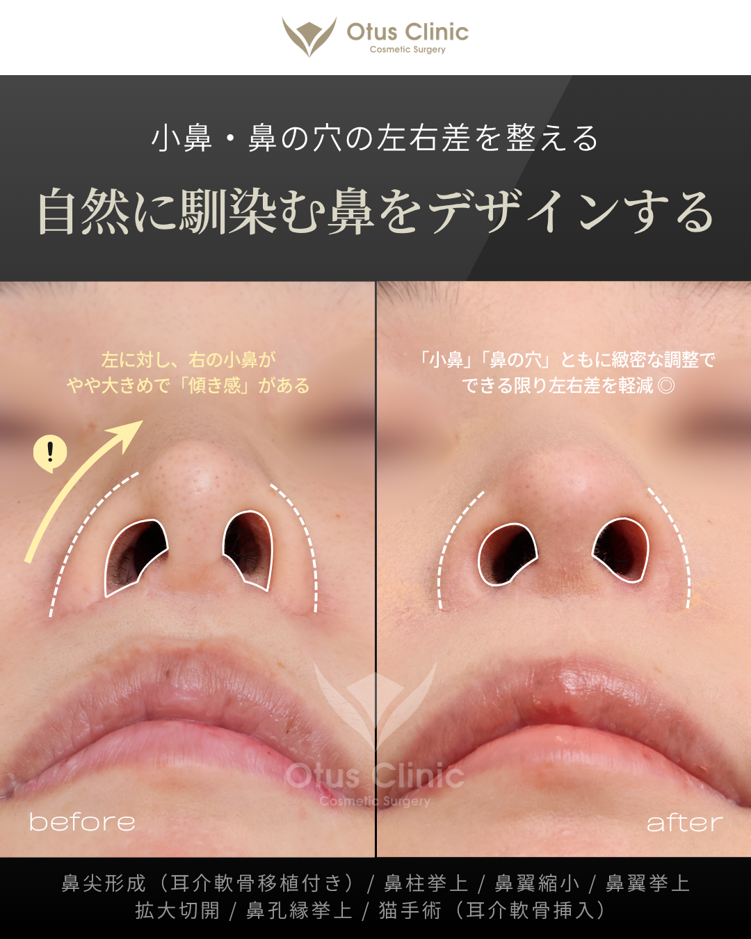 鼻尖形成（耳介軟骨移植付き）・鼻柱挙上・鼻翼縮小・鼻翼挙上・拡大切開・鼻孔縁挙上・猫手術（耳介軟骨挿入）