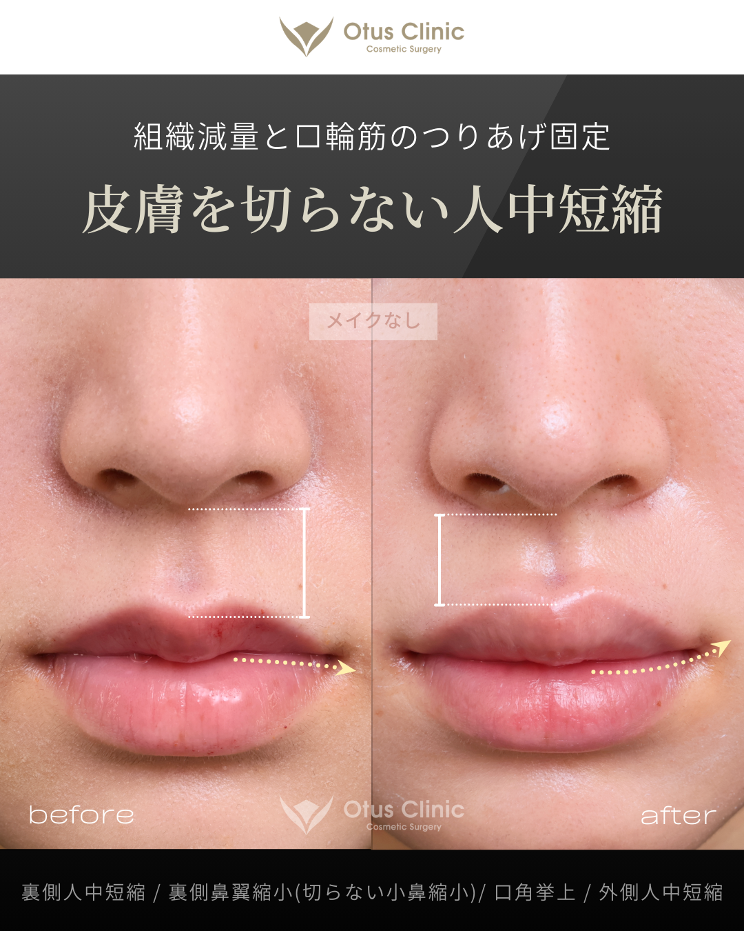 裏側人中短縮・裏側鼻翼縮小(切らない鼻翼縮小)・口角挙上・外側人中短縮