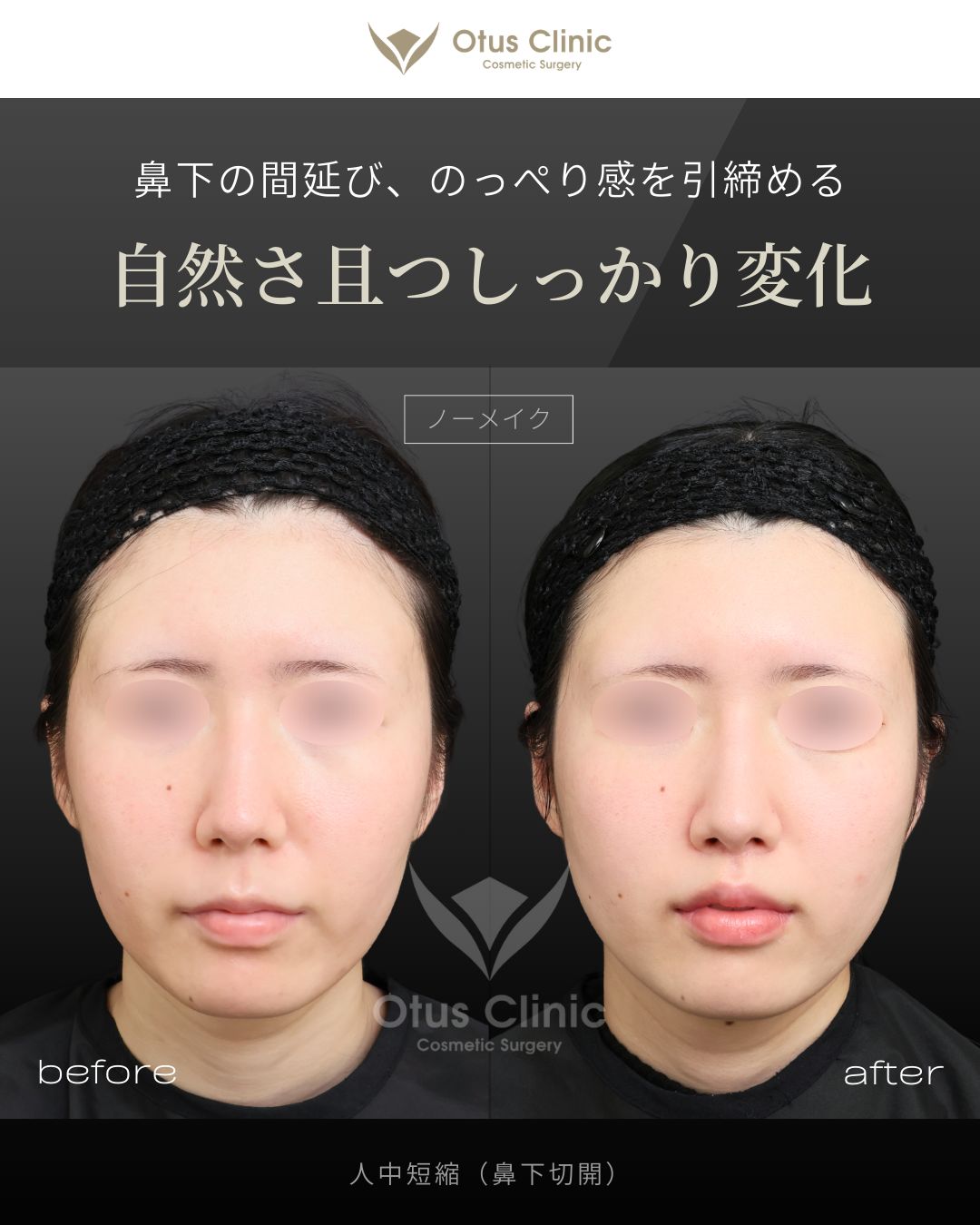 人中短縮（鼻下切開）