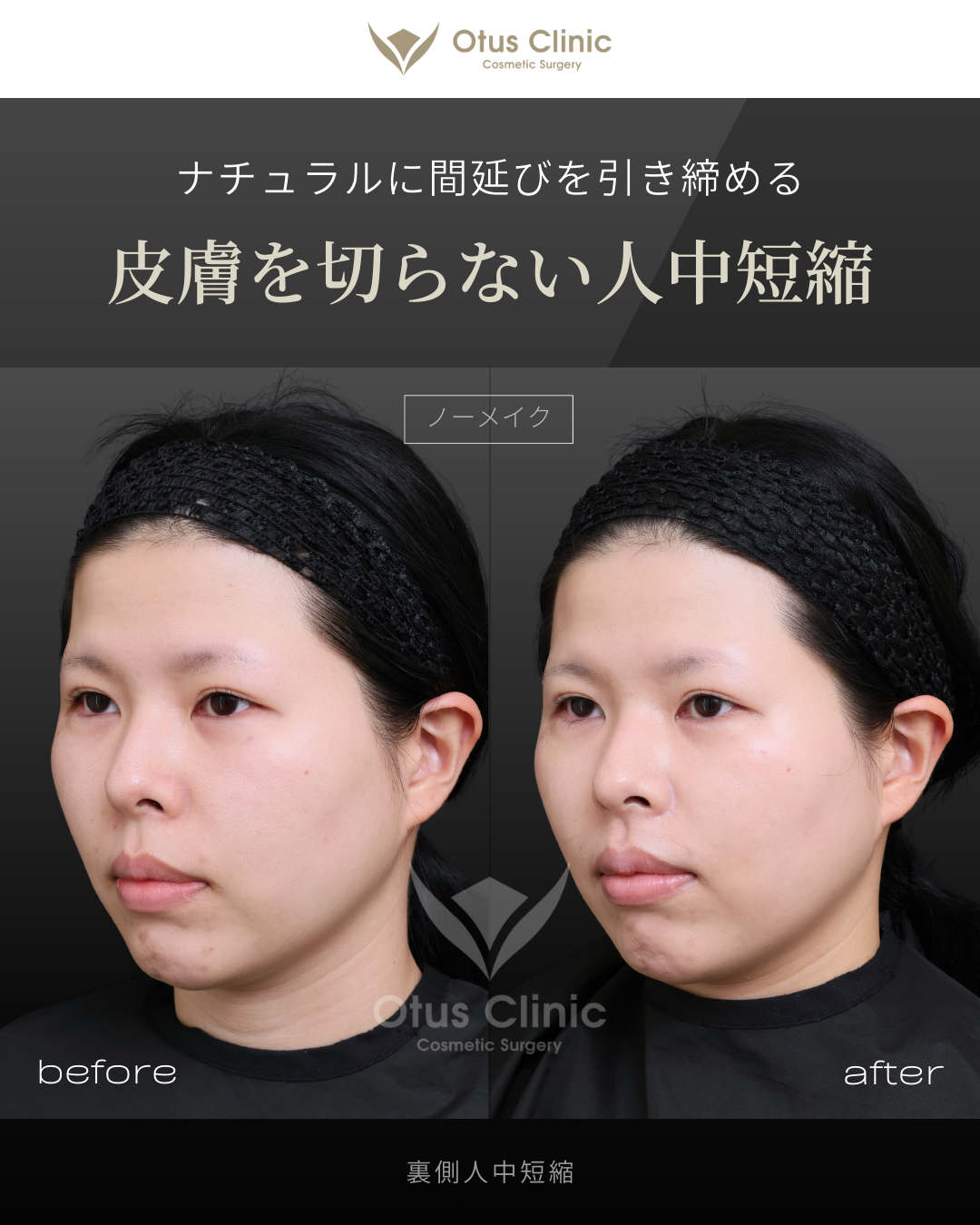 裏側人中短縮（切らない人中短縮）