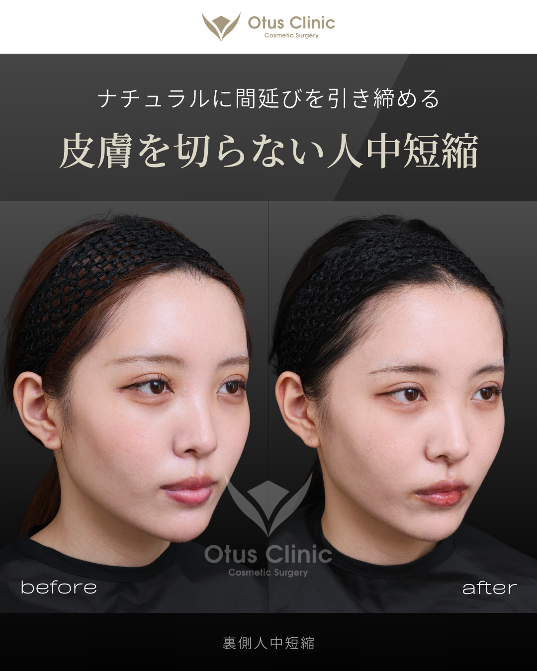 裏側人中短縮（切らない人中短縮）