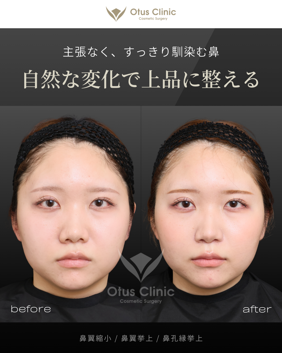 鼻翼縮小・鼻翼挙上・鼻孔縁挙上