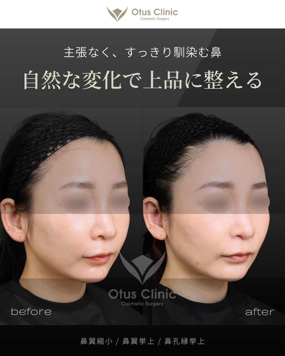 鼻翼縮小・鼻翼挙上・鼻孔縁挙上