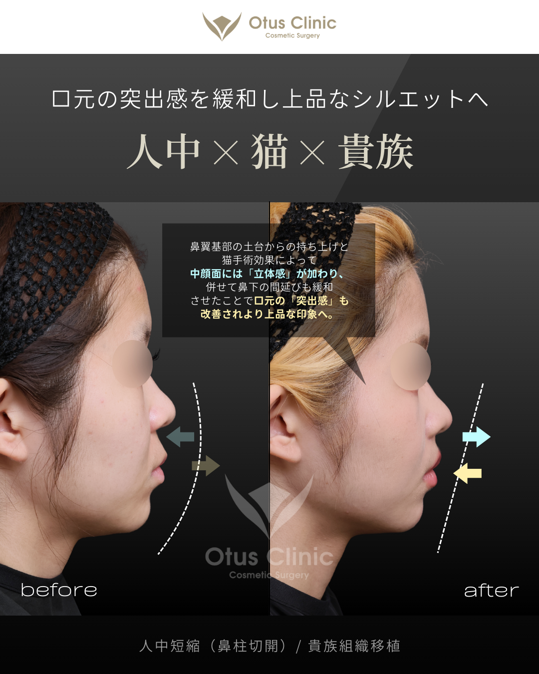鼻柱切開人中短縮・貴族組織移植