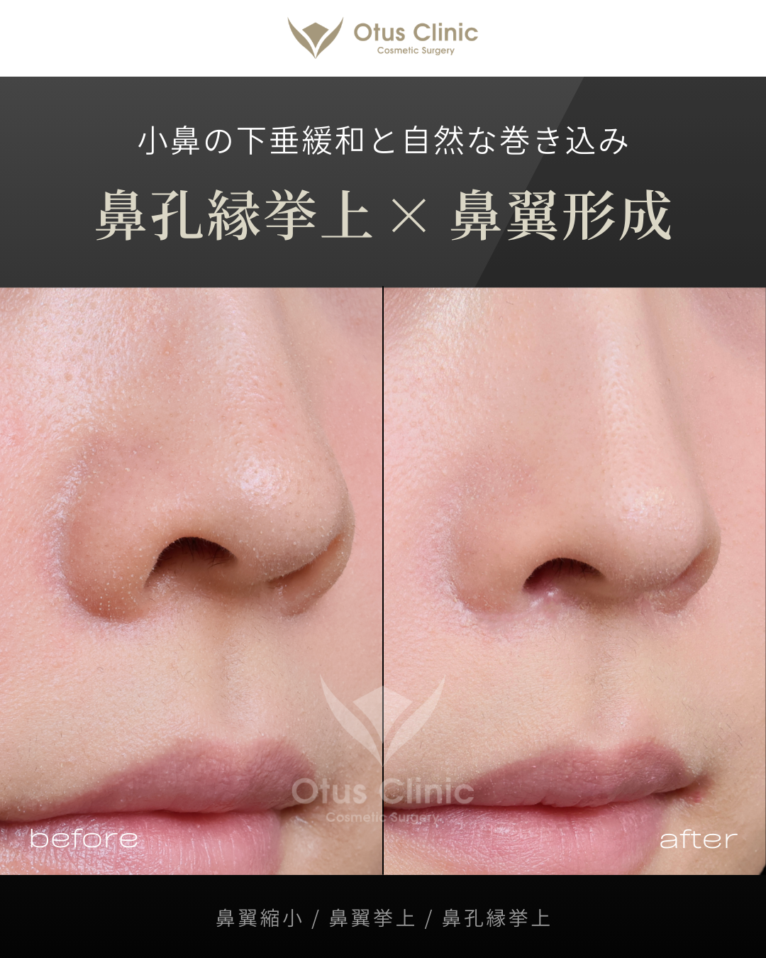 鼻翼縮小・鼻翼挙上・鼻孔縁挙上