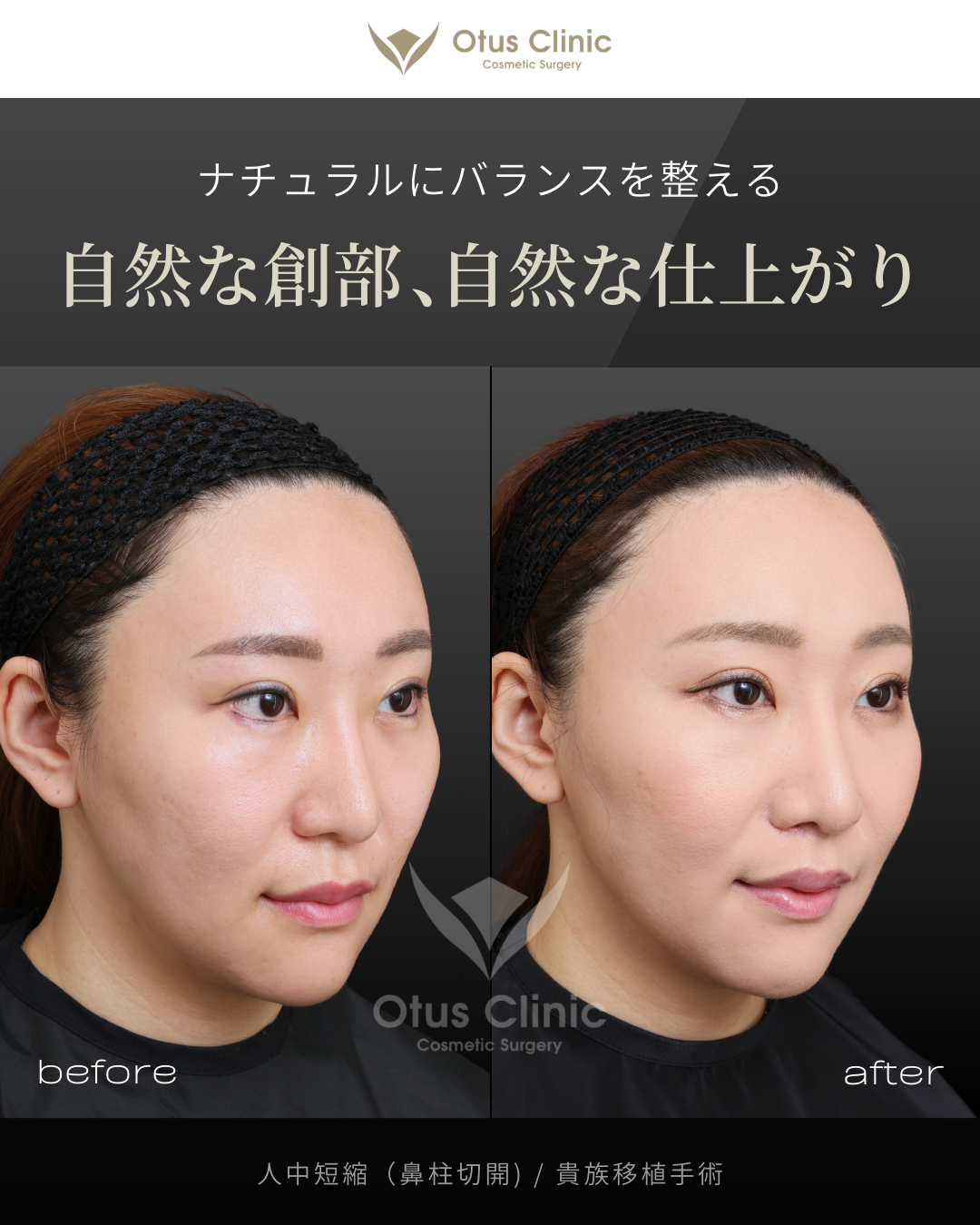 鼻柱切開人中短縮・ 貴族組織移植