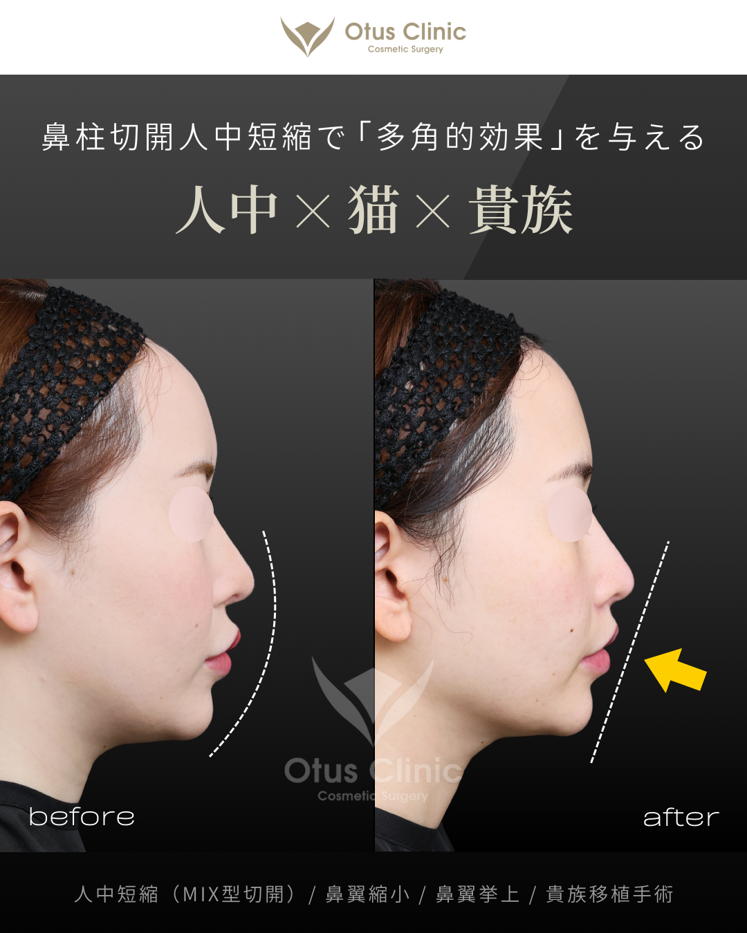 人中短縮(鼻柱切開×鼻腔内切開)・鼻翼縮小・鼻翼挙上・貴族組織移植