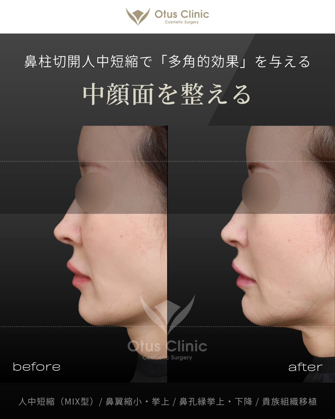 人中短縮（鼻柱切開×鼻腔内切開）・鼻翼縮小・鼻翼挙上・鼻孔縁挙上・鼻孔縁下降・貴族組織移植
