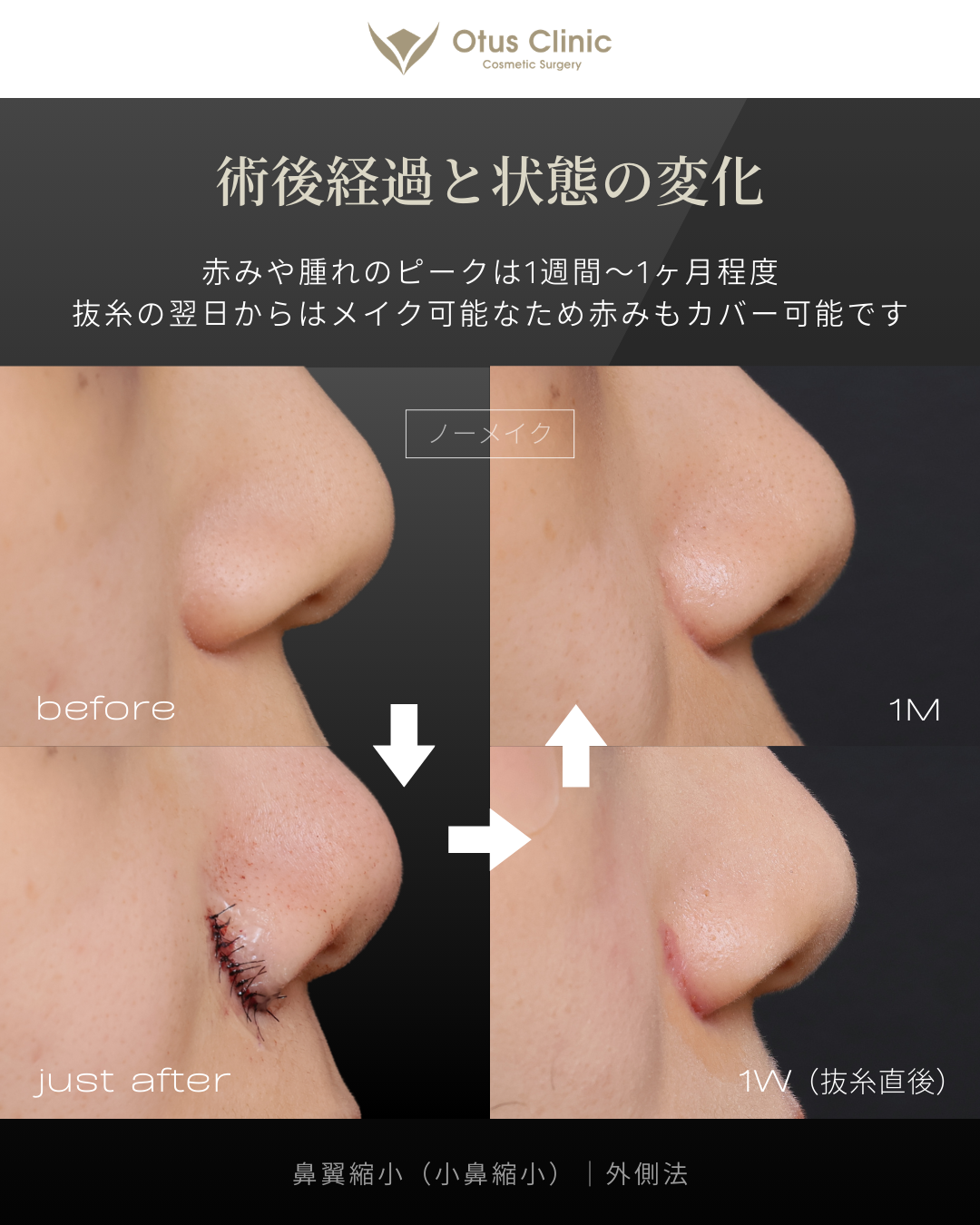 鼻翼縮小（小鼻縮小）｜外側法