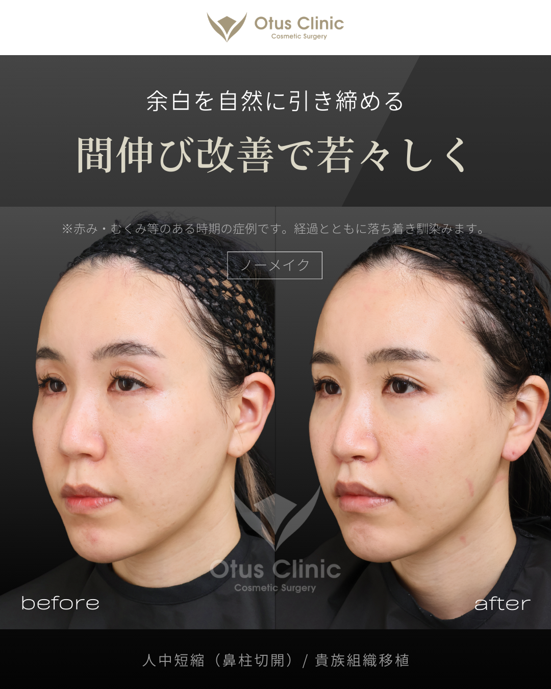 鼻柱切開人中短縮・貴族組織移植
