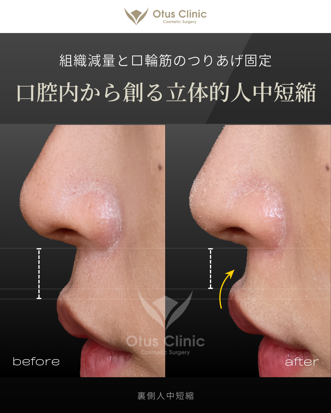 裏側人中短縮（切らない人中短縮）