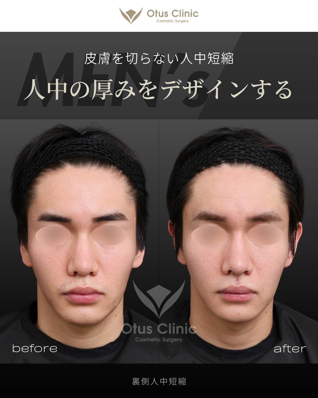 裏側人中短縮（切らない人中短縮）