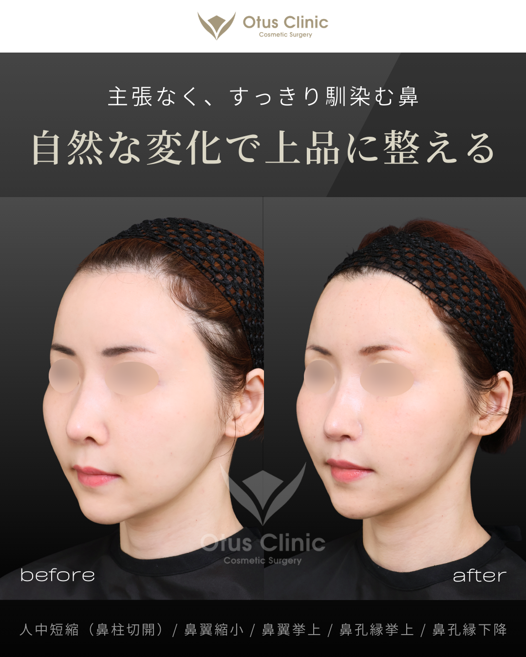 鼻柱切開人中短縮・鼻翼縮小・鼻翼挙上・鼻孔縁挙上・鼻孔縁下降